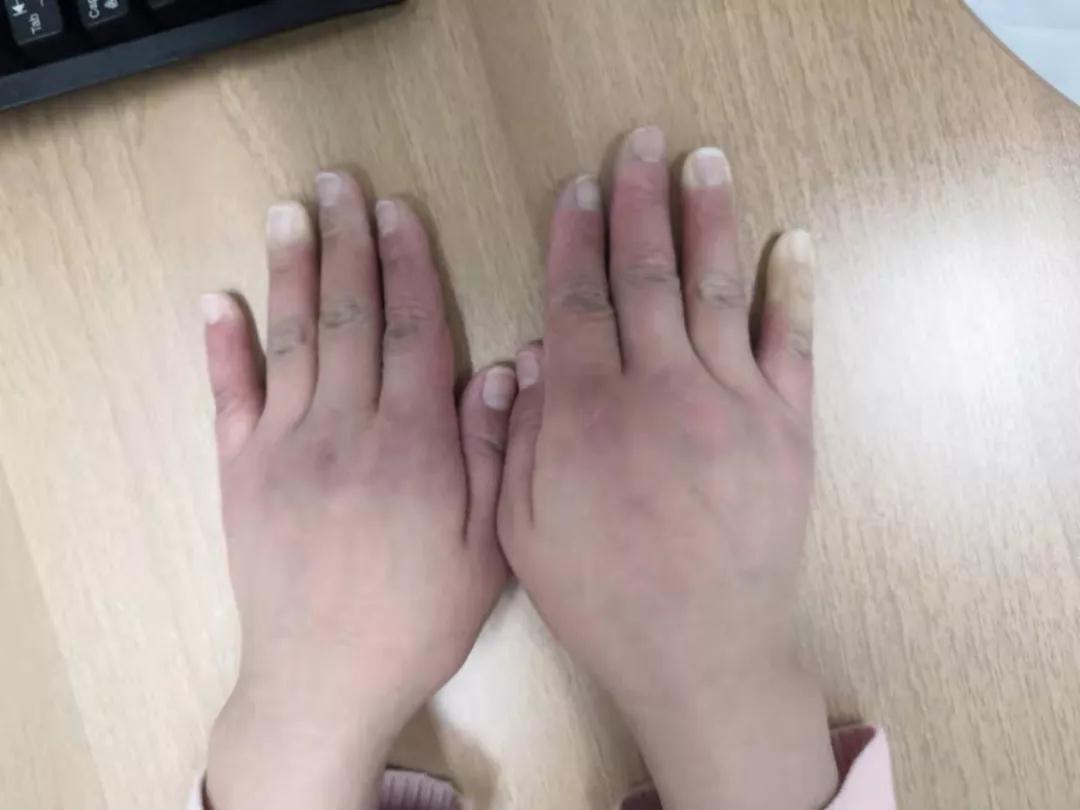 “手指、腳趾發(fā)白、發(fā)紫……”這些“小毛病”千萬別大意