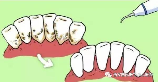 牙齒上的黃斑好難看，三招告訴你如何預防氟斑牙