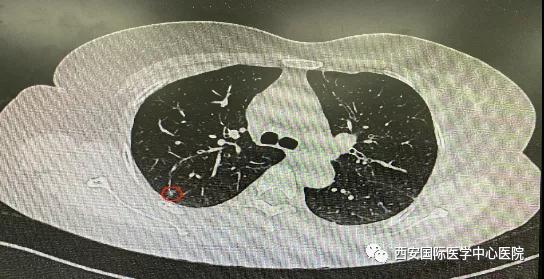 胸科醫(yī)院完成西北地區(qū)首例“Lung Pro全肺診療導航系統(tǒng)聯(lián)合單孔胸腔鏡下右肺上葉后段切除術(shù)”
