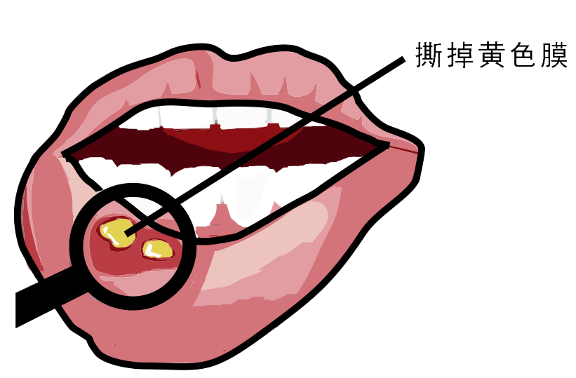 經(jīng)常口腔潰瘍，真的只是缺維生素嗎？