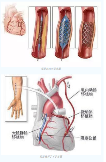 魚與熊掌不可兼得？冠脈雜交手術(shù)一站式解決問題