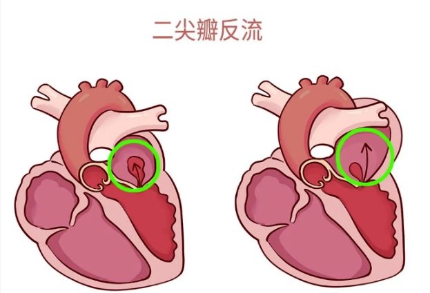 體檢報告里的心臟瓣膜返流，你讀懂了嗎？